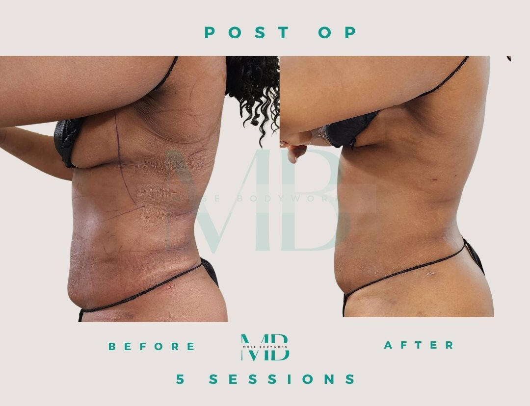 Lipo 360 post-op care results at Muse Bodywork, Mt. Laurel NJ