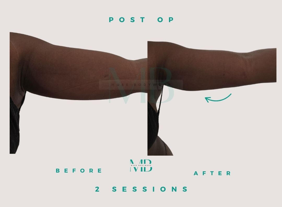 Arm Lipo post-op care results at Muse Bodywork, Mt. Laurel NJ