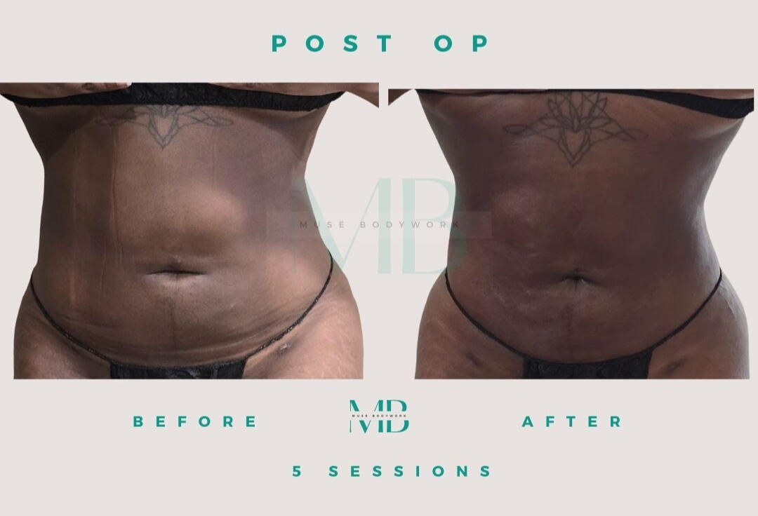 Lipo 360 post-op care results at Muse Bodywork, Mt. Laurel NJ