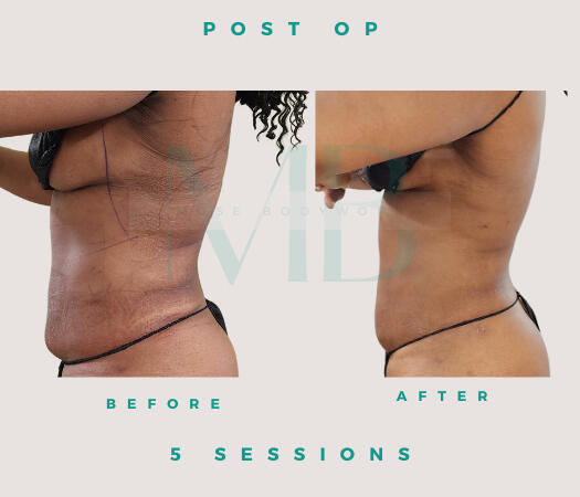 Lipo Post Op Lipo Post Op