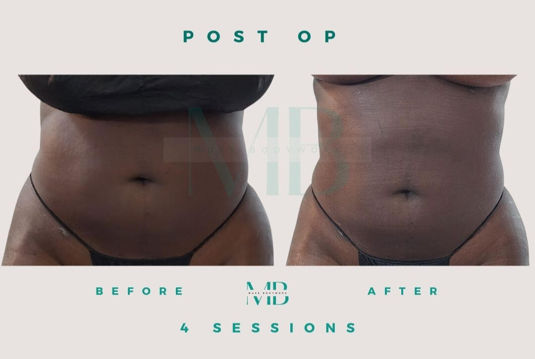 Lipo 360 post-op care results at Muse Bodywork, Mt. Laurel NJ