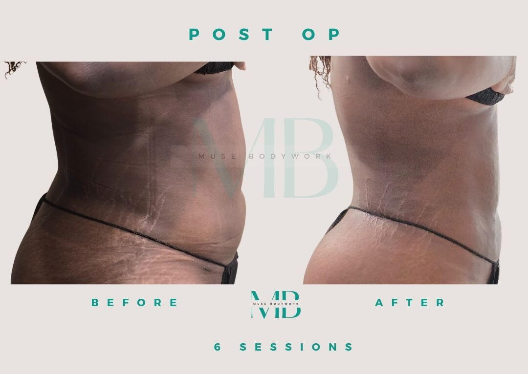 Lipo 360 post-op care results at Muse Bodywork, Mt. Laurel NJ