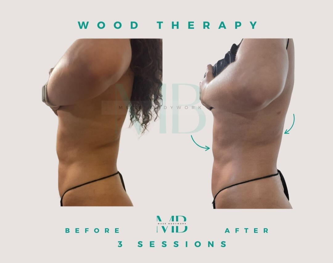 Wood therapy results at Muse Bodywork, Mt. Laurel NJ
