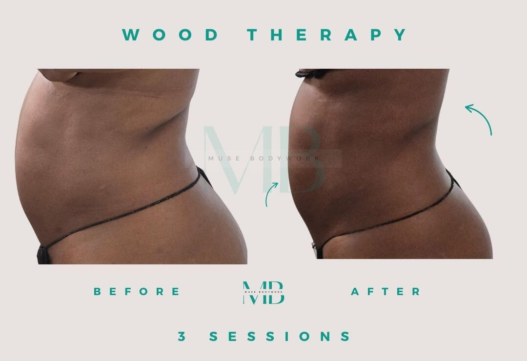Wood therapy results at Muse Bodywork, Mt. Laurel NJ
