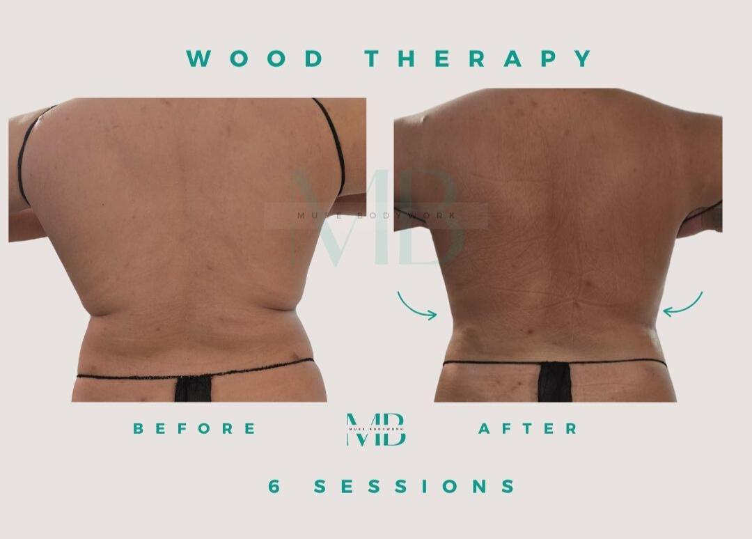 Wood therapy results at Muse Bodywork, Mt. Laurel NJ