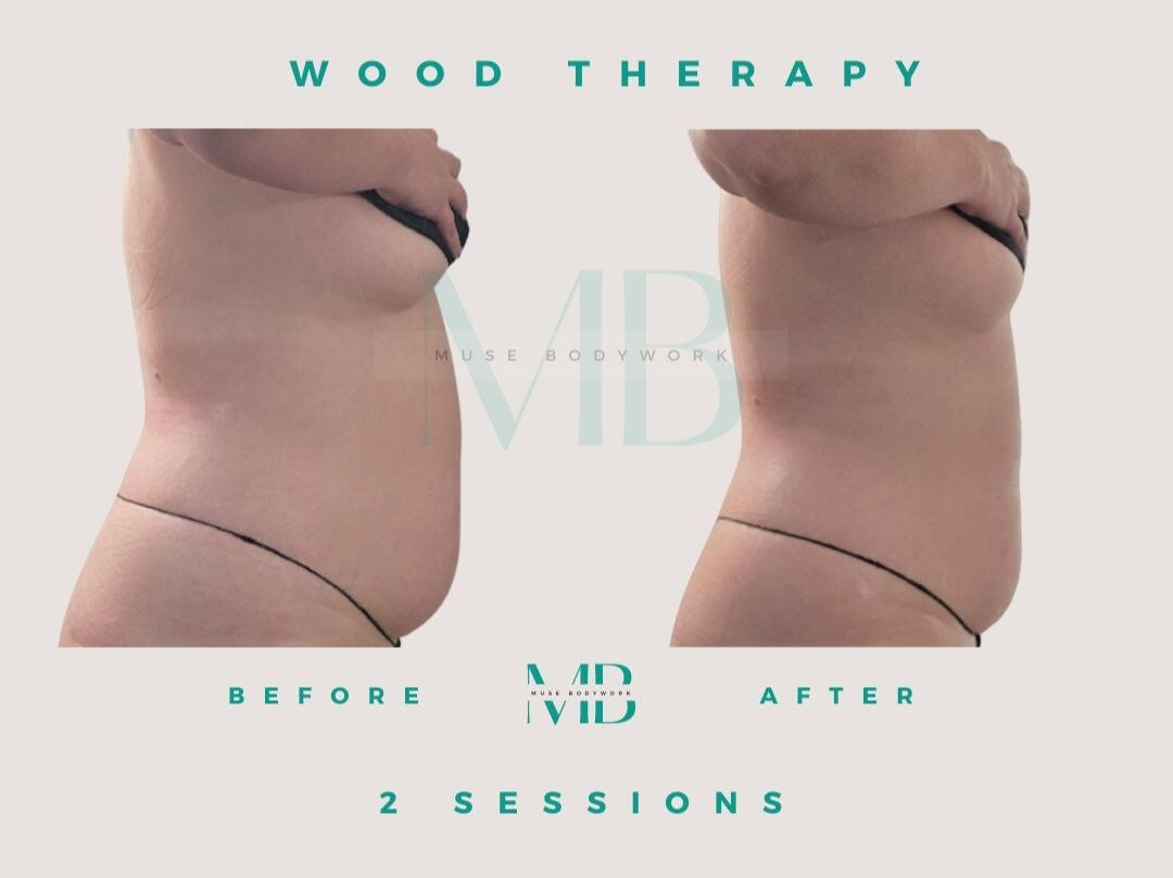Wood therapy results at Muse Bodywork, Mt. Laurel NJ