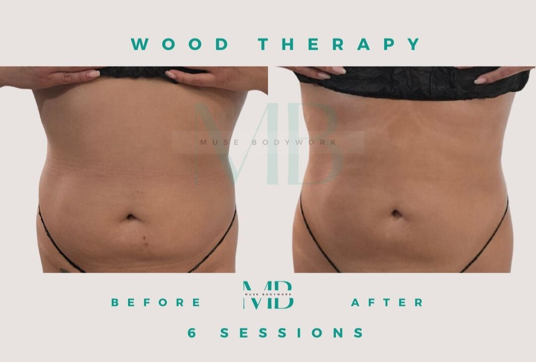 Wood therapy results at Muse Bodywork, Mt. Laurel NJ